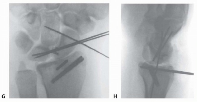 Illustration 10 for Arthroscopic Fixation: Effectively Treating Radial Styloid Fragments