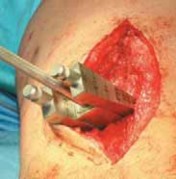 Illustration 36 for Guide Pin Assembly: Key to Flawless Upper Tibial Osteotomy