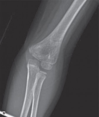 Illustration 4 for 5 Pediatric Fracture Cases: Mastering Reduction and Casting