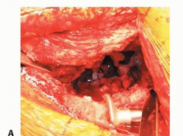 Illustration 12 for Revision Arthroplasty with Acetabular Bone Loss: The Antiprotrusio Cage