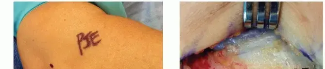 مرفق التنس (التهاب اللقيمة الوحشية): دليل شامل للمرضى نحو التعافي في اليمن والخليج العربي