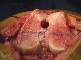 Illustration 26 for Posterior Stabilized Technique: Essential Insights for TKA Success