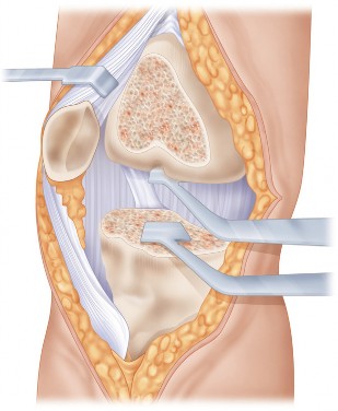 Illustration 38 for Mastering Valgus Total Knee Replacement: Techniques & Pitfalls