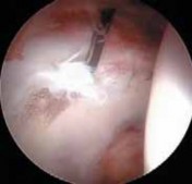 Illustration 15 for Resolving Femoral Head Neck Impingement: Arthroscopic FAI Solutions