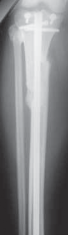 Illustration 61 for Optimal Nailing of the Tibia: Techniques for Challenging Fractures