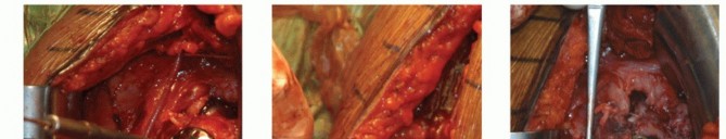 Illustration 20 for Optimizing Fixation of Proximal Humerus Fractures: A Guide