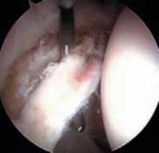 Illustration 16 for Resolving Femoral Head Neck Impingement: Arthroscopic FAI Solutions