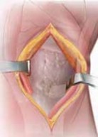 Illustration 23 for Guide Pin Assembly: Key to Flawless Upper Tibial Osteotomy