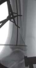 Illustration 66 for Optimal Nailing of the Tibia: Techniques for Challenging Fractures