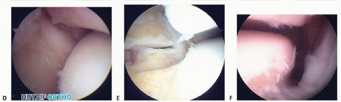 Mastering Posterior Subtalar Joint Arthroscopy: What You Need to Know
