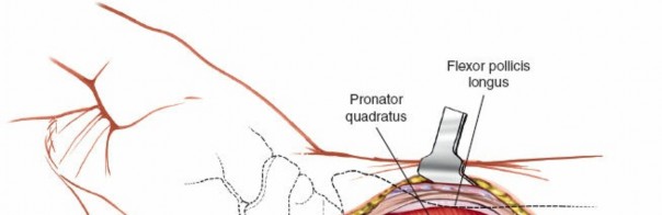 Illustration 6 for Volar Approach: Optimal Exposure for the Volar aspect of the Distal Radius