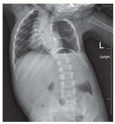Vertical Expandable Prosthetic: Growing Lungs, Correcting Scoliosis