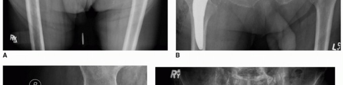 Illustration 10 for PJI of the Hip: Two-Stage Revision: When & How to Prepare