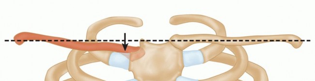 Illustration 12 for Optimizing SC Dislocation Repair After Medial Clavicle Resection
