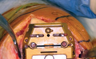 صورة طبية: استبدال مفصل الركبة بالحد الأدنى من التدخل الجراحي: ألم أقل وتعافٍ أسرع مع النهج شبه الرضفي الإنسي