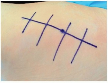 Illustration of direct lateral approach - Dr. Mohammed Hutaif