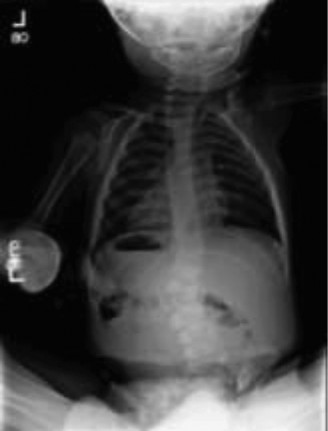 Illustration 3 for Cracking 11 Pediatric Cases: The Bar with Contralateral Guide