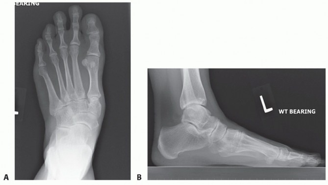 Illustration 56 for Mastering Midfoot Arthrodesis: Protect the Deep Neurovascular Bundle