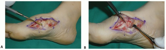 Illustration 42 for Mastering Midfoot Arthrodesis: Protect the Deep Neurovascular Bundle