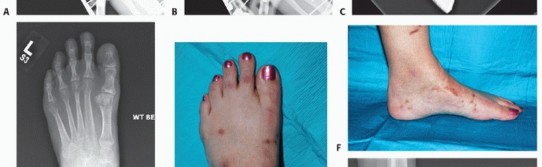 Illustration 68 for Mastering Midfoot Arthrodesis: Protect the Deep Neurovascular Bundle