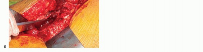 Illustration 6 for Surgical Hip Dislocation Safety: The Branch of the MFCA's Vital Role