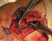 Illustration 35 for Optimal Fixation of the Ankle: Open Reduction & Internal Fixation