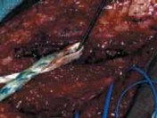 الدليل الشامل لعلاج الالتحام المعيب للكسور وتشوهات العظام ما بعد الإصابات