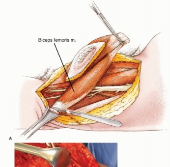 Illustration 18 for Posterior Thigh Resection: Rethinking Outcomes & Limb Sparing