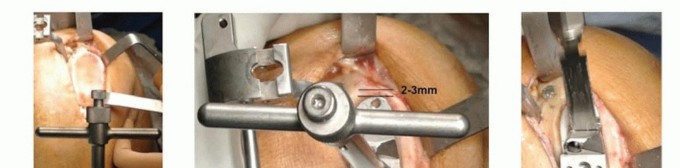 صورة طبية: استبدال مفصل الركبة الجزئي: حل متقدم لآلام الركبة المستمرة مع الأستاذ الدكتور محمد هطيف