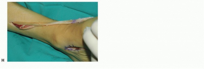 Illustration 10 for Foot Drop Surgery: How a Pin or Drill Elevates Tendon Transfer