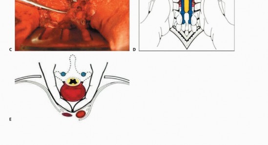 Illustration 21 for Total En Bloc Spondylectomy: Complete Resection for Spinal Tumors