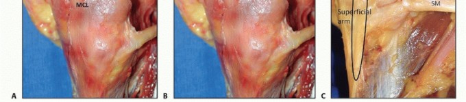 Illustration 5 for Repair & Recover from Collateral Ligament Injuries: Your Guide