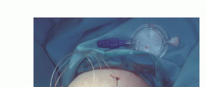 Illustration 26 for Above-Elbow & Below-Elbow Amputations: When & Why They're Needed