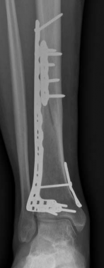 Illustration 22 for Complex Tibial Shaft Fracture: Plate Fixation for Plafond Extension