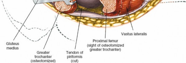 Illustration 115 for Unlocking Every Aspect of the Hip's Surgical Approaches