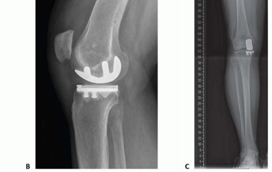 صورة طبية: استبدال مفصل الركبة الجزئي: حل متقدم لآلام الركبة المستمرة مع الأستاذ الدكتور محمد هطيف