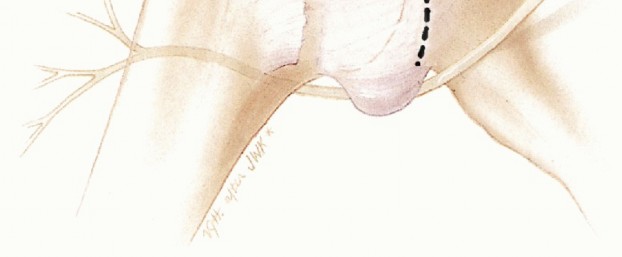 Illustration 21 for Bankart Repair & Inferior Capsular Shift: Solving Shoulder Instability