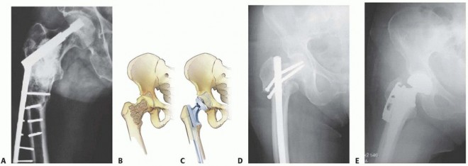 Illustration 10 for Regain Mobility: Total Hip Arthroplasty for Malignant Lesions
