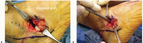 Illustration 21 for Lateral Column Lengthening: Relieve Flatfoot Pain & Correct Deformity