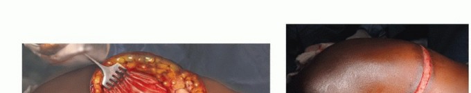 Illustration 25 for Pelvic Metastasis Surgery: A Component of the Utilitarian Approach