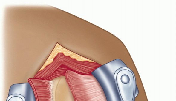 Illustration 25 for Finally Treat Recurrent Posterior Instability of the Shoulder