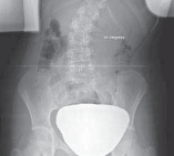 Illustration 6 for Mastering Anterior Interbody Arthrodesis with Instrumentation for Scoliosis