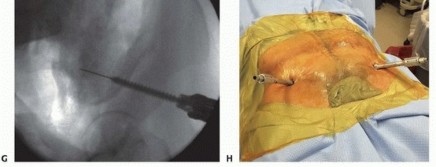 Illustration 38 for Emergency Fixation of the Pelvis: Control Bleeding & Restore Stability