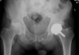 Illustration 6 for Patient Case: Resurfacing Primary Hip Arthroplasty for Lasting Relief
