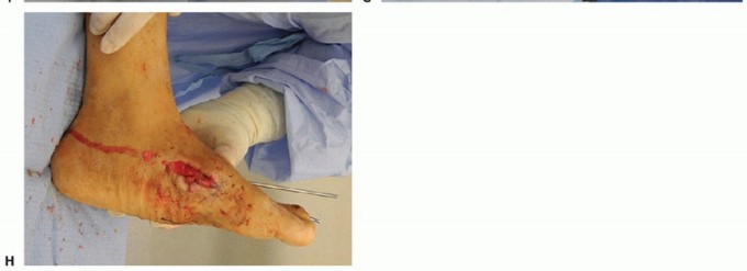 Illustration 20 for Regain Mobility: Surgical Solutions for Charcot Foot Arthropathy