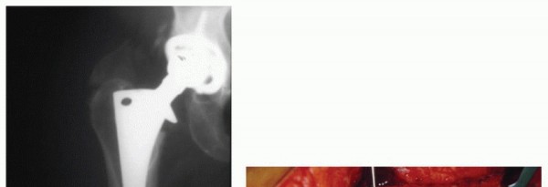 Illustration 2 for PJI of the Hip: Two-Stage Revision: When & How to Prepare