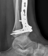 Illustration 24 for Complex Tibial Shaft Fracture: Plate Fixation for Plafond Extension