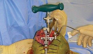 Illustration 14 for Optimize Tibial Component Alignment: Techniques for TKA Success