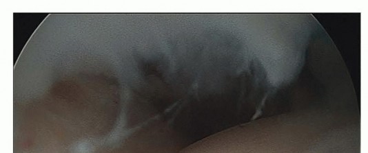 Illustration 3 for Hip Arthroscopy: Your Minimally Invasive Solution for Hip Pain