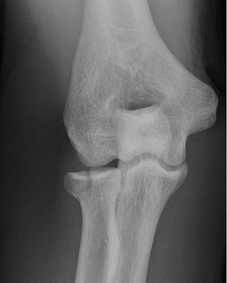 Illustration 3 for Stiff Elbow Cases: Diagnosing & Treating Post-Traumatic Contractures